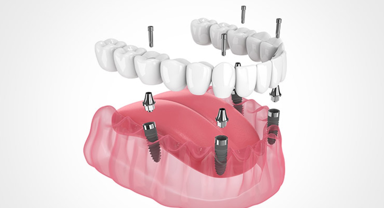 implant-supported dentures in Middletown OH