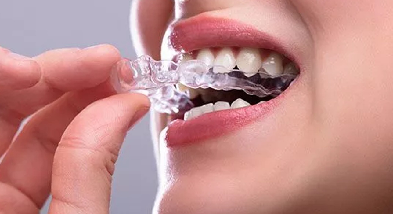 Custom Night Guards for Teeth Grinding at MK&C Dental in Middletown, OH
