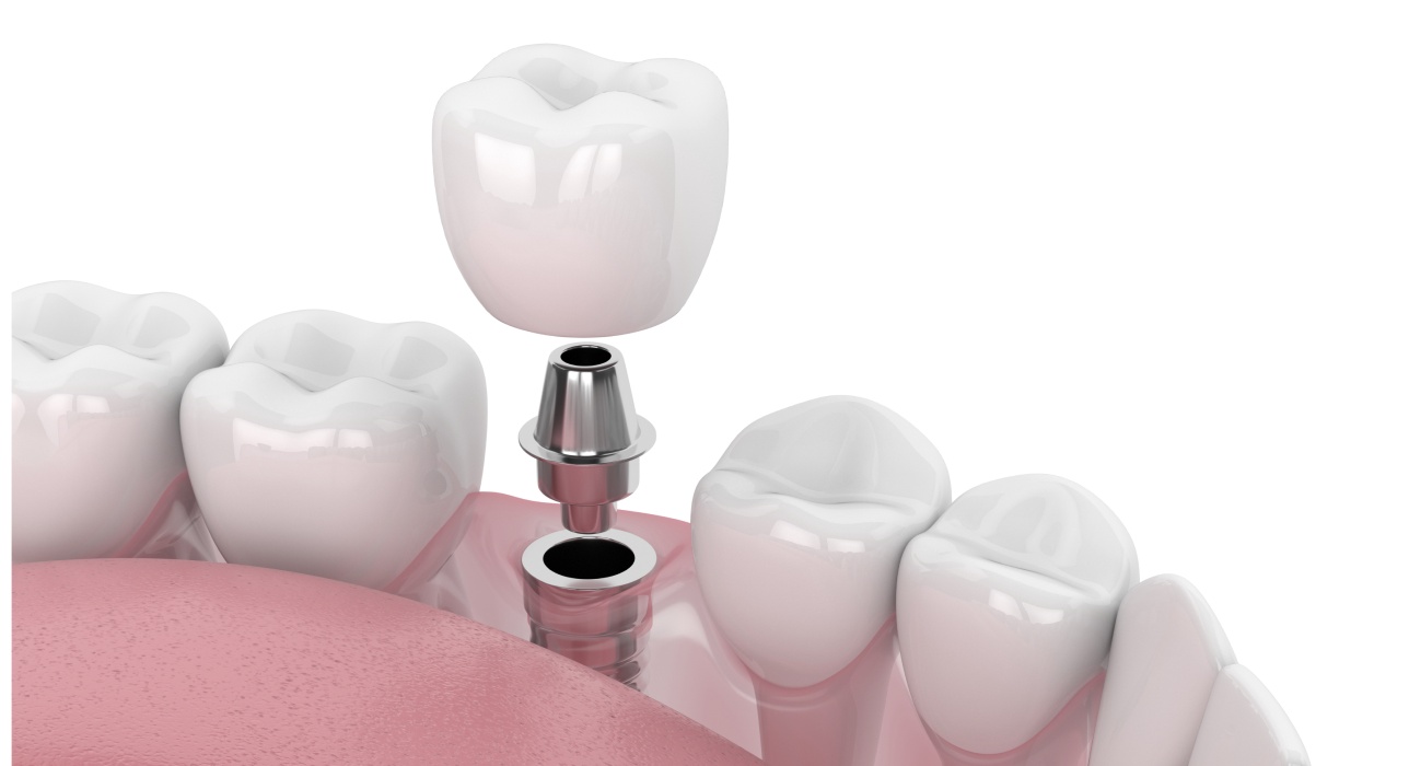 Single dental implant procedure in Middletown OH